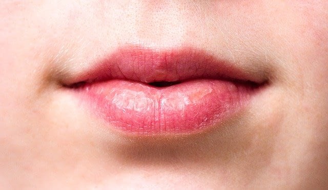 dry lips and CBD lip balm